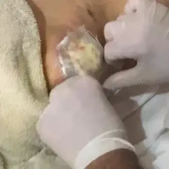 Curaciones y Tratamiento De Heridas o Escaras