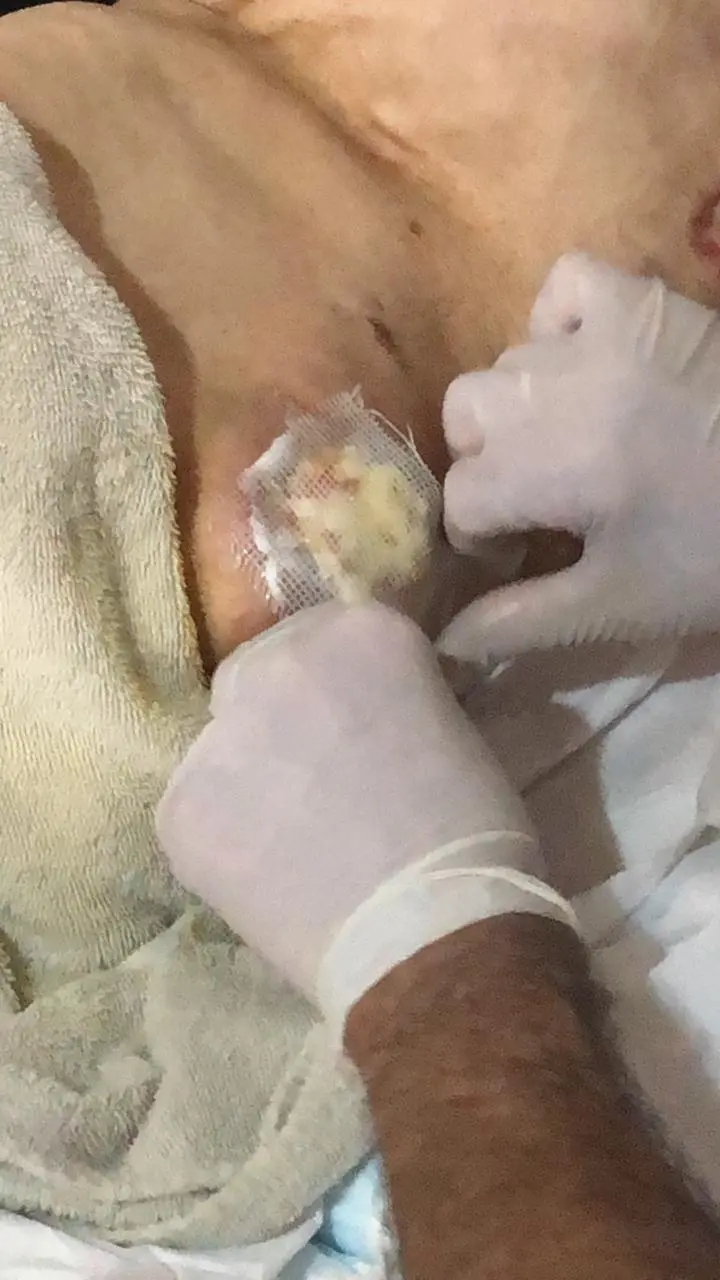 Curaciones y Tratamiento De Heridas o Escaras